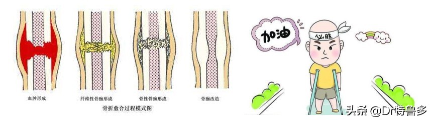 骨折了不长、长得慢怎么办?试试冲击波治疗吧