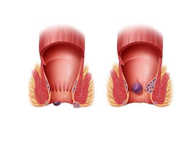 肛门长了个“小肉球”，是痔疮吗？若是痔疮，一片树叶就够了