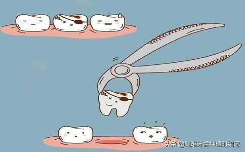 牙根拔出来好还是不拔好,拔牙根之前需要注意什么