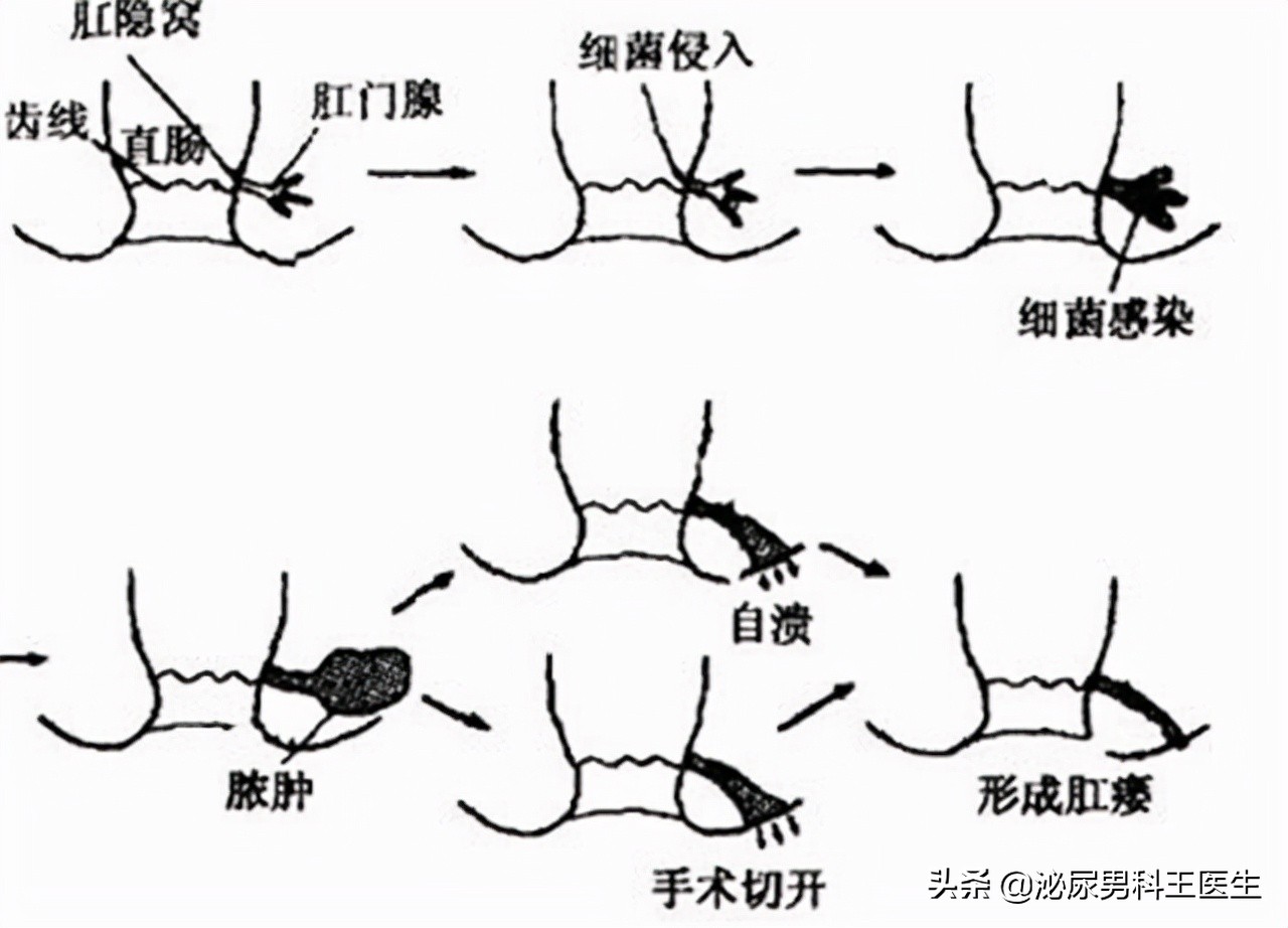 肛瘘不治是不是头疼,肛瘘患者不敢手术
