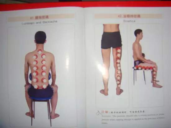 拔罐有哪些穴位图解,最全拔罐穴位疗法图解