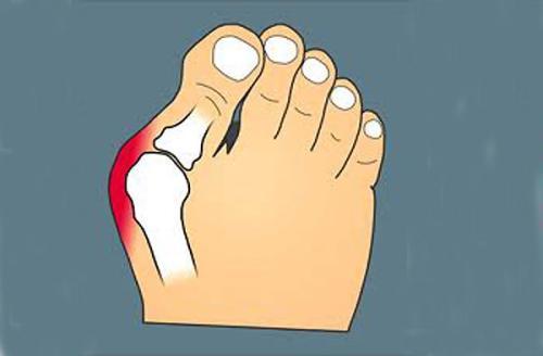 拇外翻克星,拇趾外翻畸形