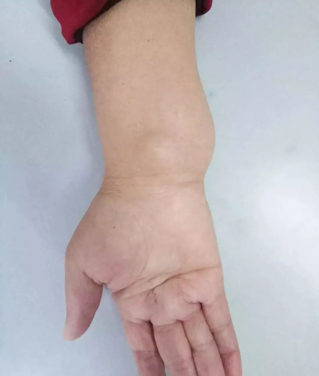 许昌阿姨怪病,84岁老人突然查出恶性肿瘤