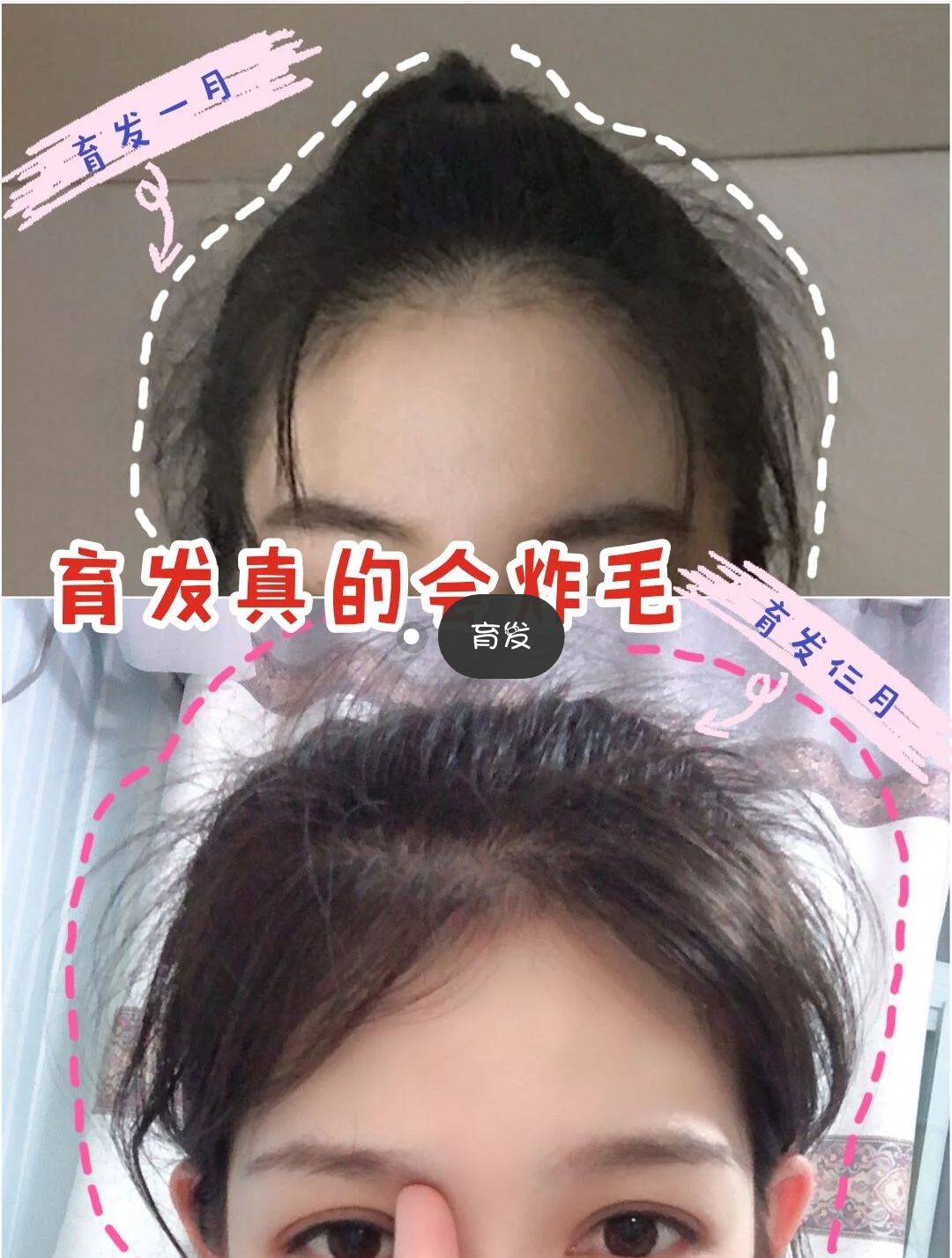 脱发秃顶发际线高如何防脱生发,改善脱发掉发问题守住发际线