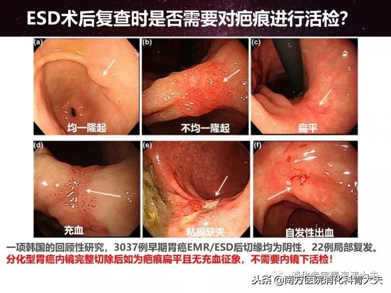 早期胃癌内镜手术后评估,早期胃癌内镜下EMR和ESD适应症