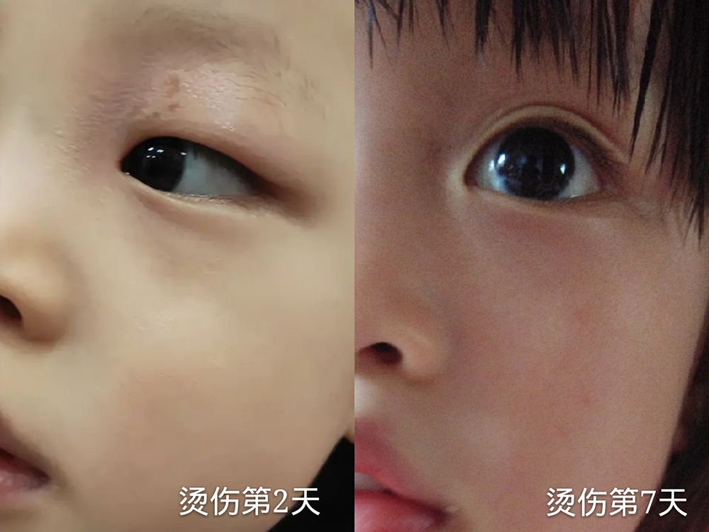 如何让宝宝远离烧烫伤,宝宝夏天烫伤的护理及注意事项