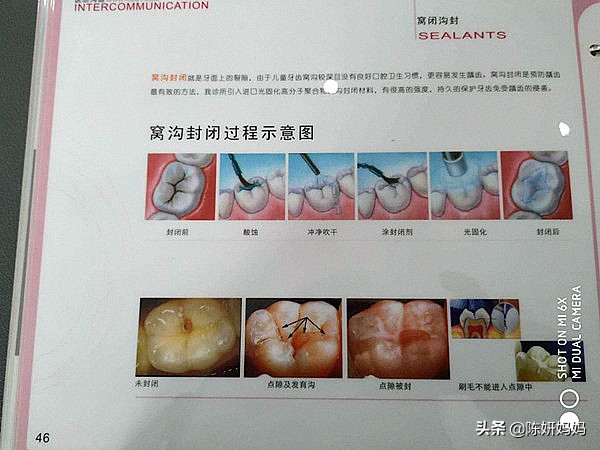 蛀牙都是吃糖惹的祸？别冤枉孩子了，牙医告诉你实情！