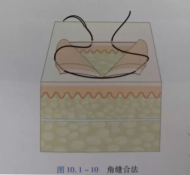 伤口闭合的正确方法,伤口清创的详细步骤