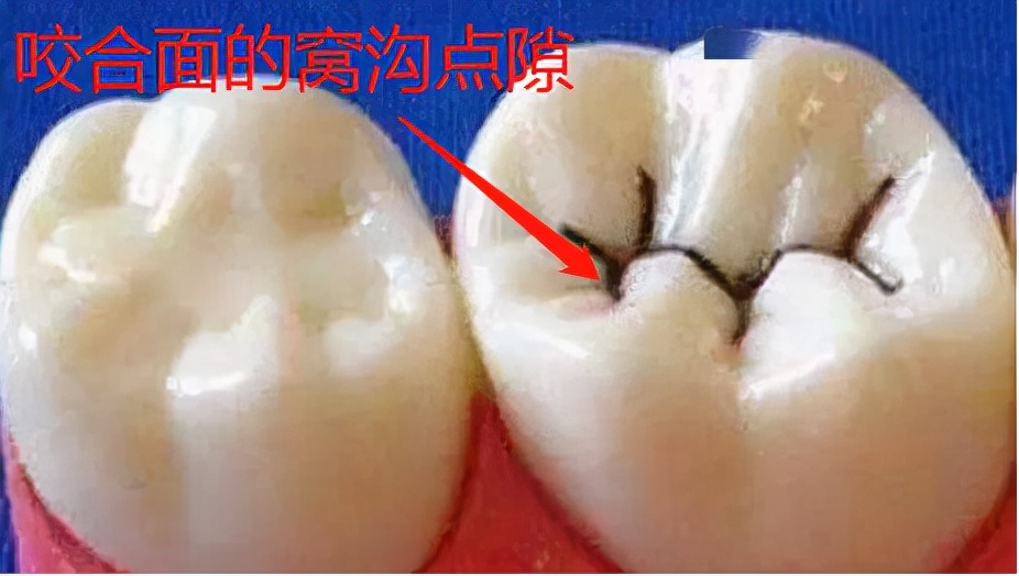 u型牙刷是不是要用专用牙膏,儿童牙刷u型口含全自动2-12岁用法