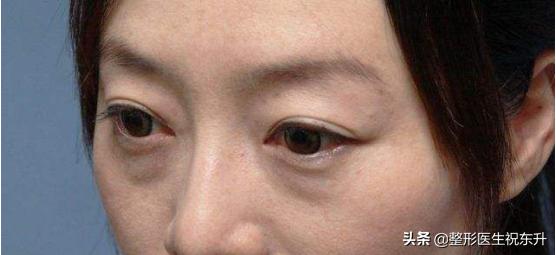 眼袋越来越重是身体哪里出问题了,为什么你会有眼袋