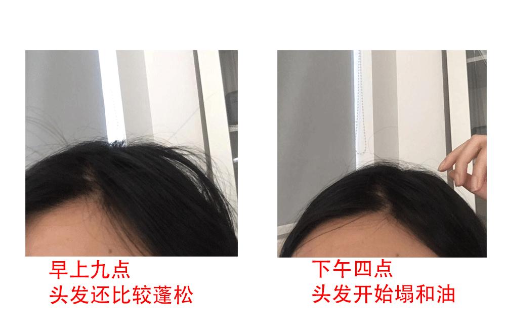 头发易出油头皮多怎么回事,头皮上有螨虫头发掉怎么办