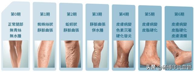腿部静脉曲张这几天痒怎么缓解,下肢静脉曲张腿部瘙痒怎么消除