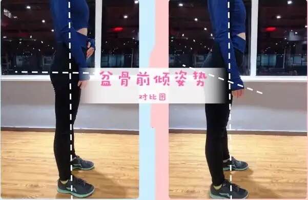 久坐会导致骨盆前倾还是骨盆后倾,开车久坐会导致骨盆前倾怎么纠正