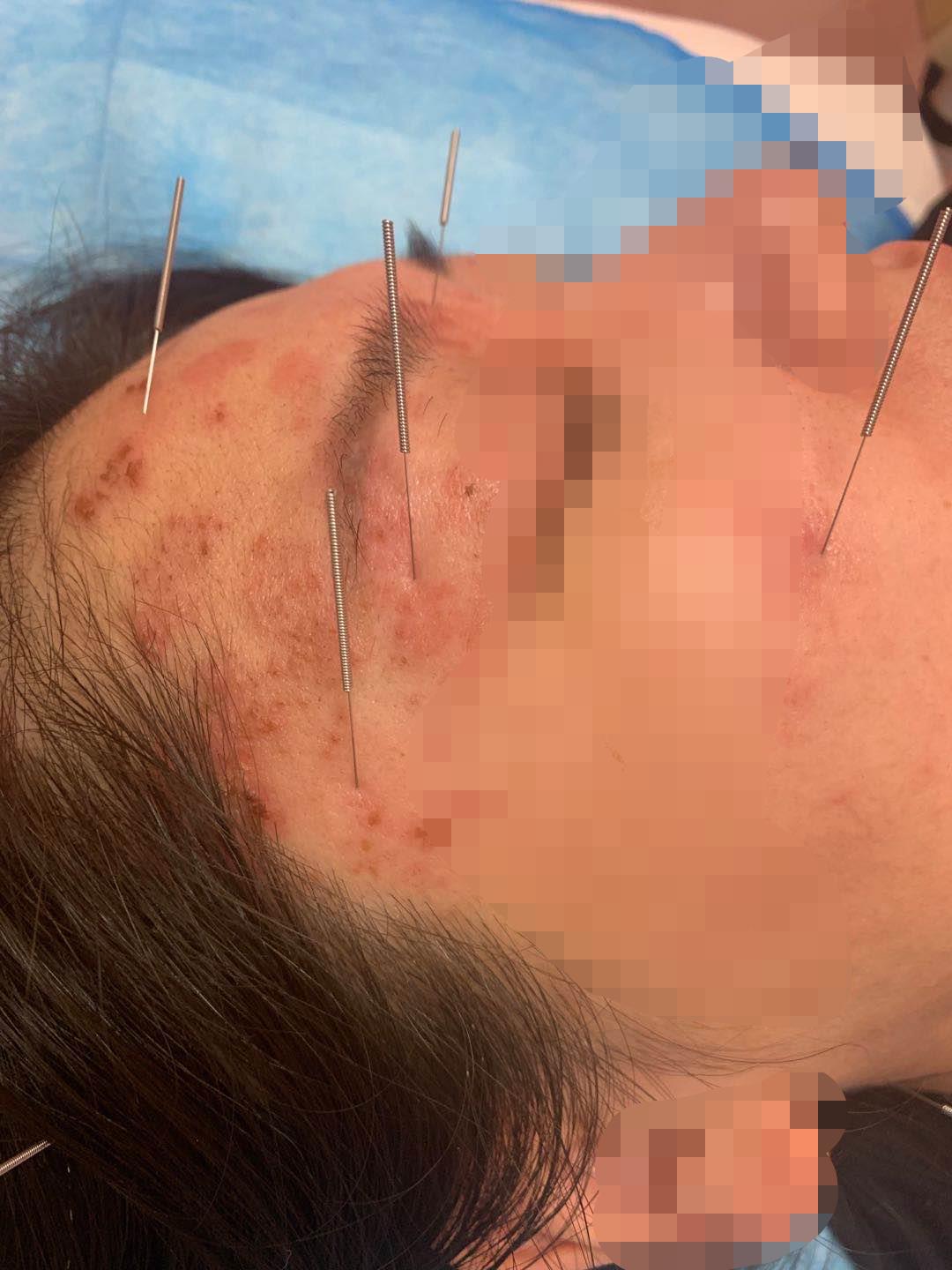 疱疹后遗神经痛针灸可以治愈吗,疱疹涂了药膏感觉更加严重了