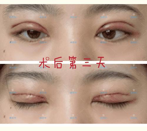 原来双眼皮不好看有必要继续割吗,双眼皮越看越奇怪怎么办