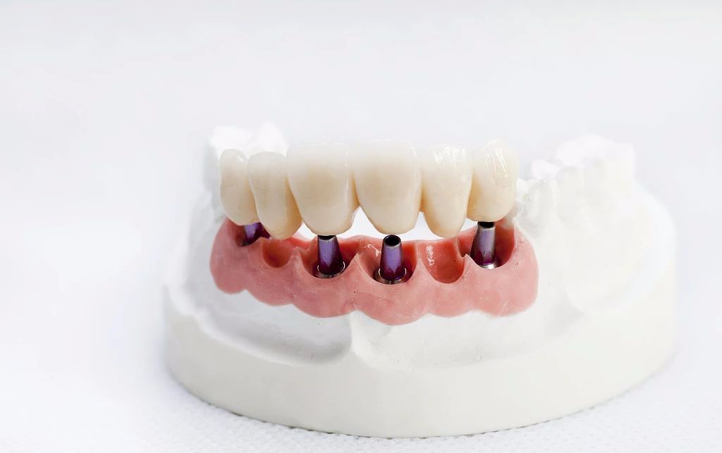 种植牙价格表影响因素,全口种植牙价格受哪些因素的影响