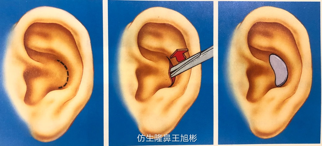 耳软骨隆鼻和肋软骨隆鼻图片对比,耳软骨隆鼻和假体耳软骨隆鼻