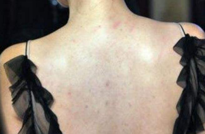 后背痘痘频发，又痒又难看，2物让你轻松告别痘痘背