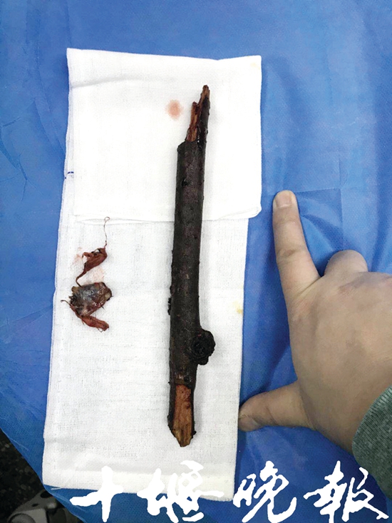 十堰一女子摘樱桃时跌落30厘米长断枝插进下身直至腹腔！