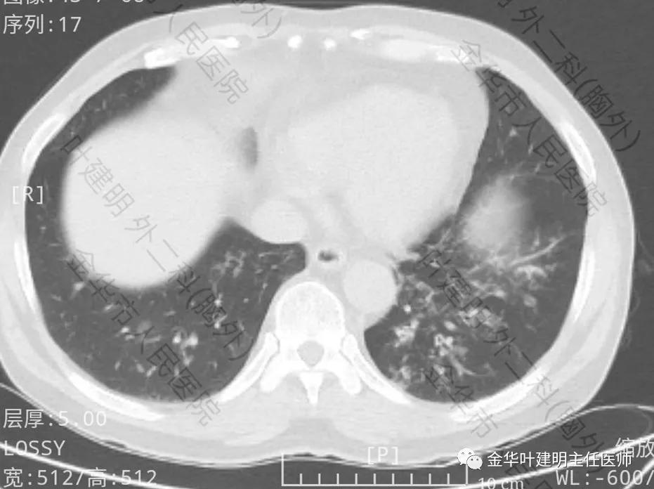 肺多发转移癌主要治疗手段,右肺上叶癌怎么治疗