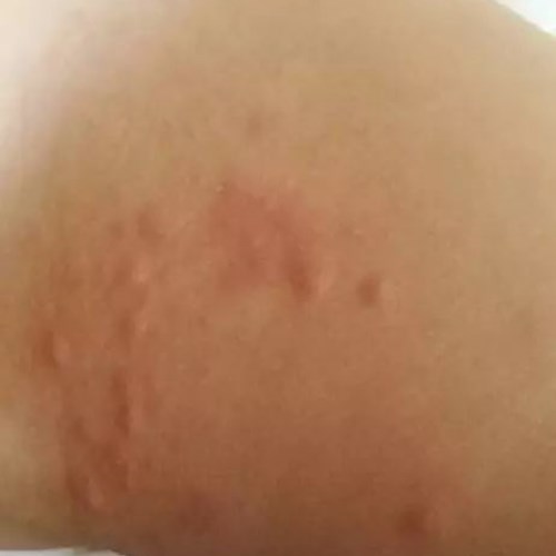 宝宝小疙瘩,宝宝小疙瘩是什么样的