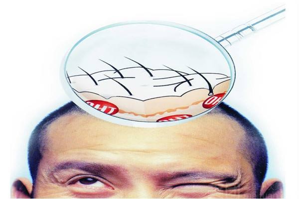 该怎么知道自己有没有脱发,不知道自己什么原因脱发