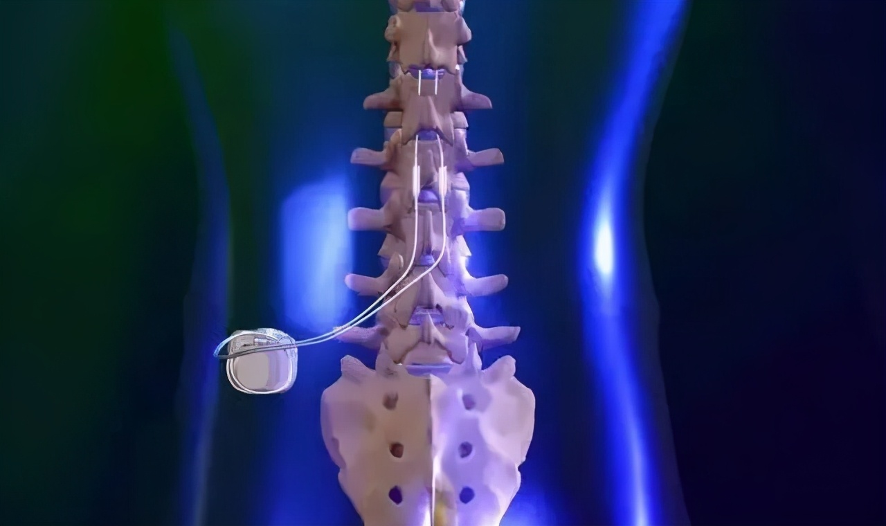 脊髓电刺激术治疗顽固性疼痛,脊髓电刺激术可以恢复运动功能嘛