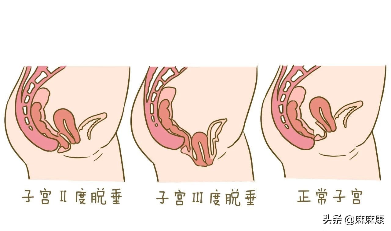 怎么样自检盆底肌情况,产后怎么自检盆底肌