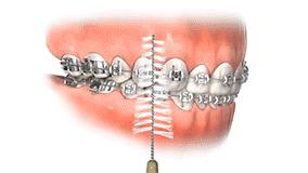 初戴牙套吃什么食物,单颗牙戴牙套怎么固定