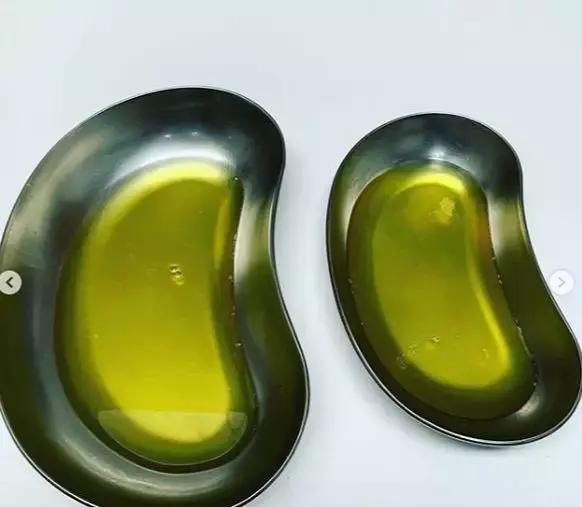 骨科大夫谈关节积液怎么处理,关节有积液怎么治疗才能彻底根除