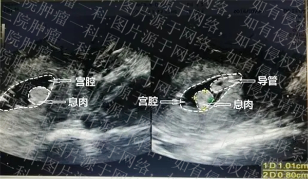 子宫内膜癌推荐广州医院,广州中山肿瘤医院子宫内膜癌