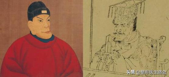 面中部凹陷下巴微翘,朱元璋式下巴怎么矫正