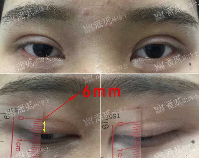 双眼皮手术科普：割双眼皮七大常见误区，您中招了几个？