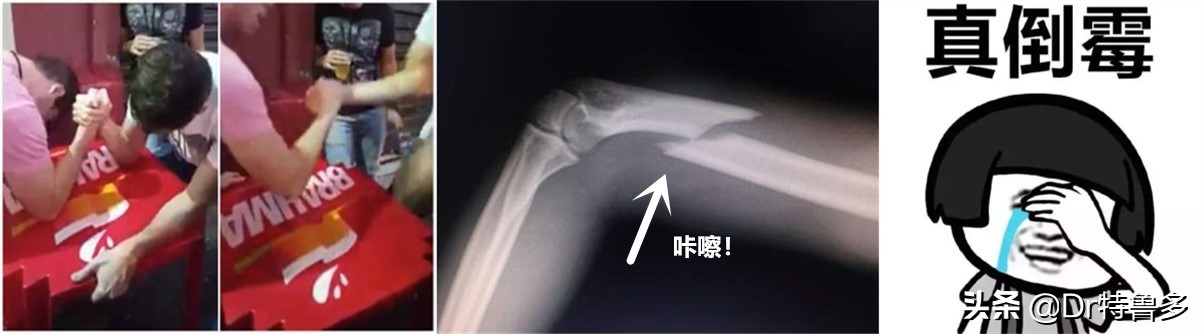 骨折能避开灾祸是迷信么,骨折恢复后腿有坑是怎么回事