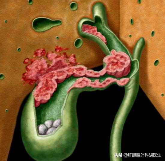 胆囊结石伴随胆囊息肉怎么办,胆囊息肉已经1.9厘米了会不会癌变