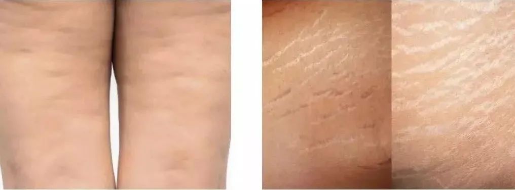 为什么我明明不胖看起来却很胖,不算特别胖但是长特别多的肥胖纹