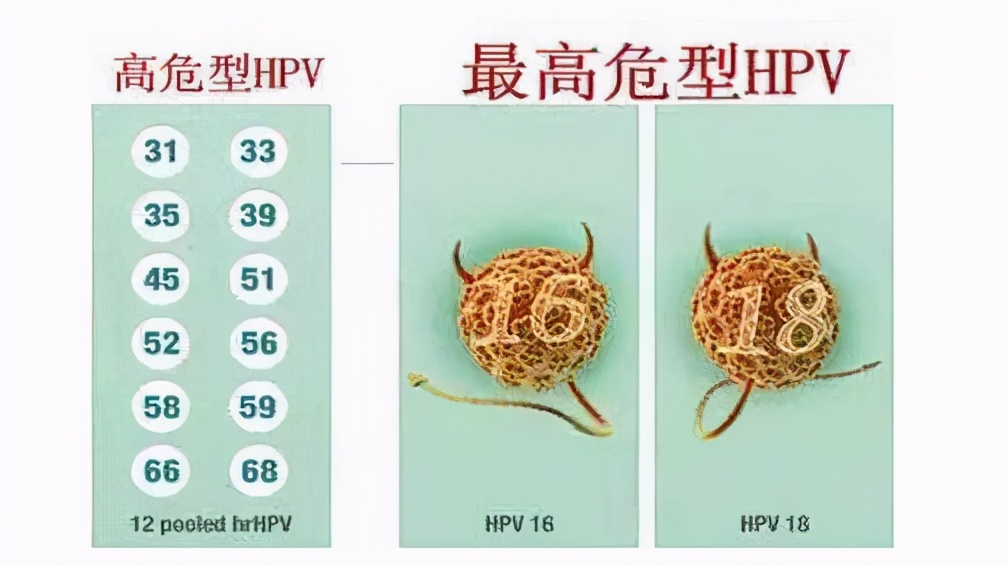 持续感染hpv18几年阳性tct正常,tct正常hpv18阳性到底用不用治