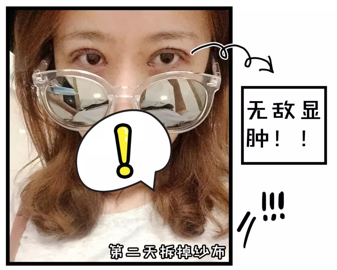 割双眼皮术前术后对比图,割双眼皮术前需要注意事项