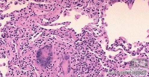 常见的肺间质疾病,常见血管疾病