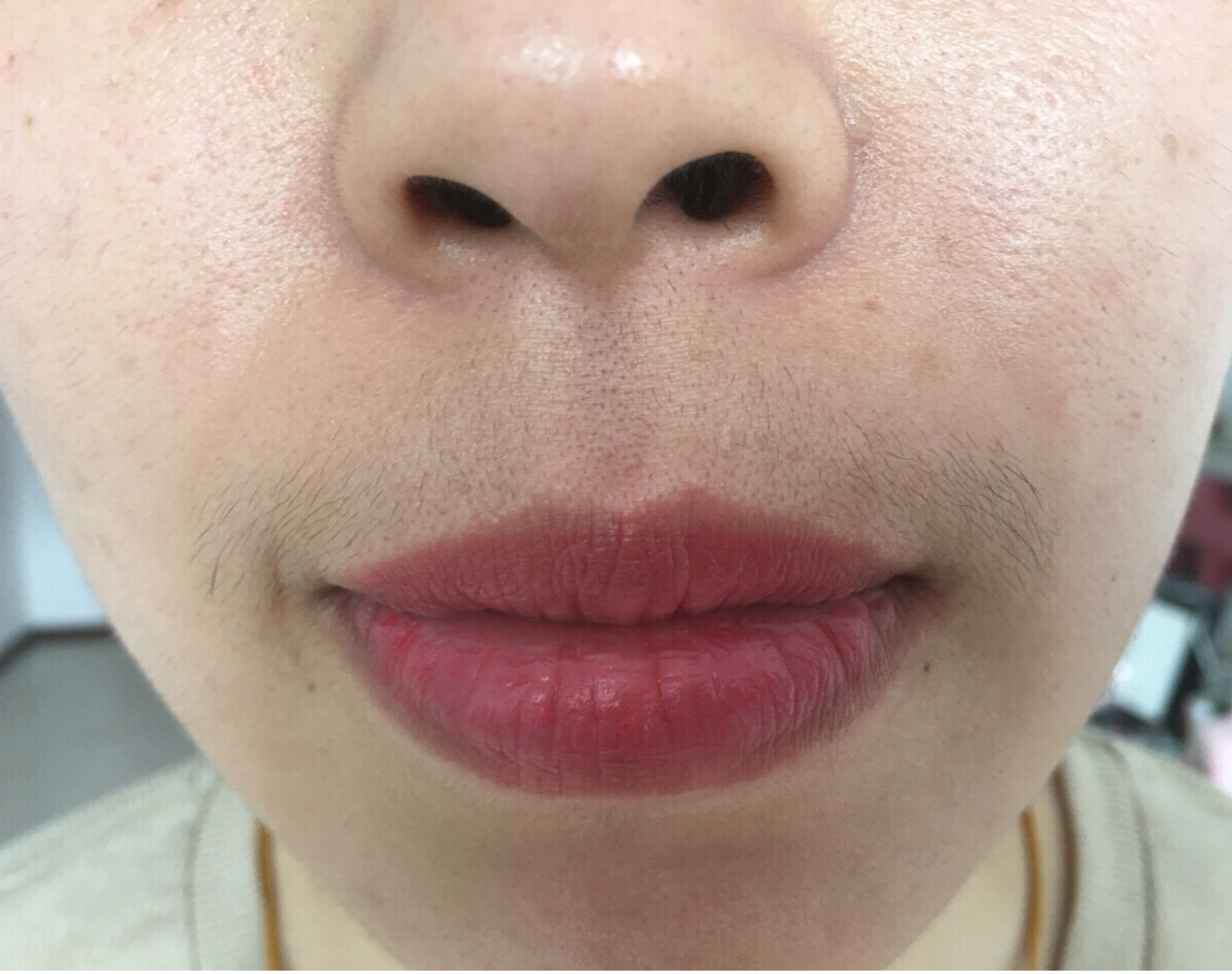 如何去除唇周小胡子,小胡子唇周黑怎么去除