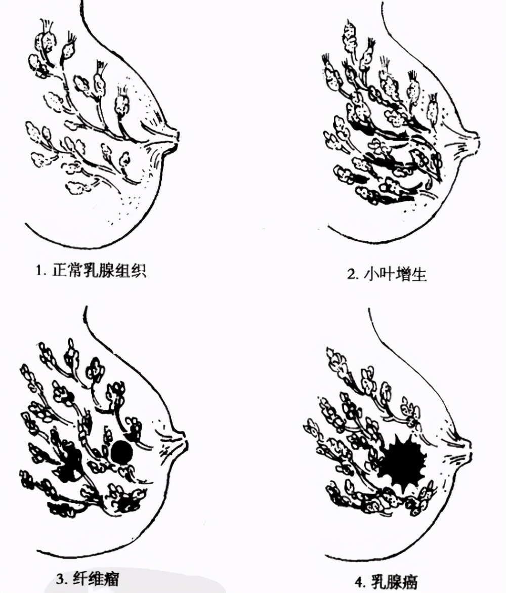 一来月经乳房胀痛特别严重,一来月经乳房右侧疼怎么回事