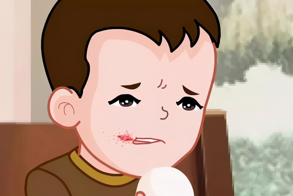 口角炎反复发作有黄结痂,儿童口角炎反复发作