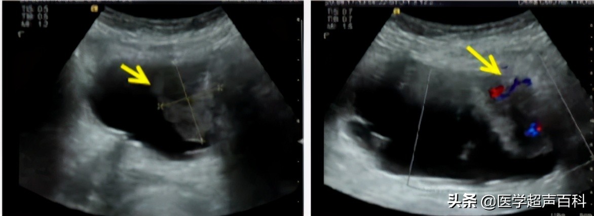 膀胱最常见肿瘤,膀胱肿瘤最常见最早的症状