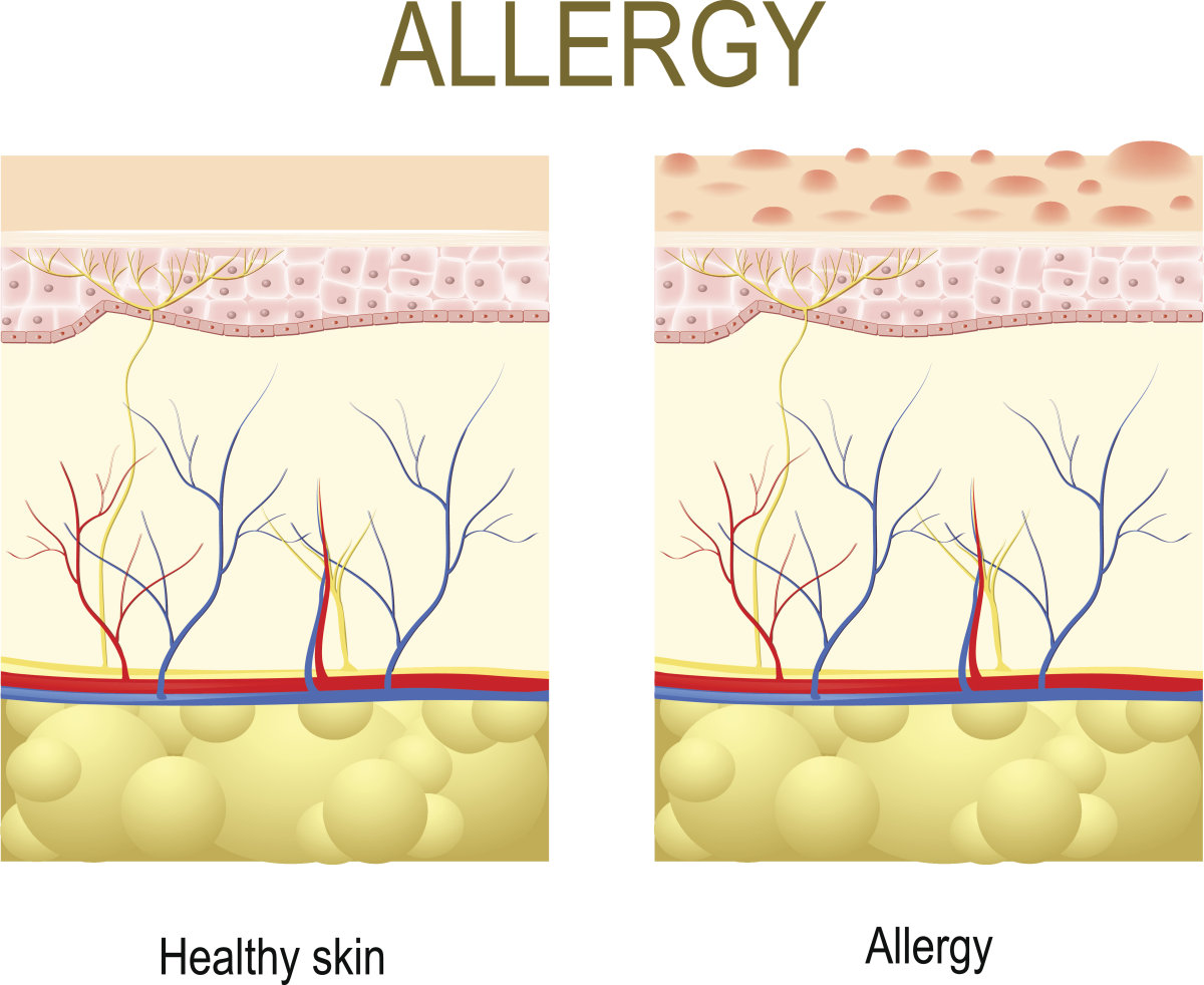 资深过敏人士,过敏而死的人
