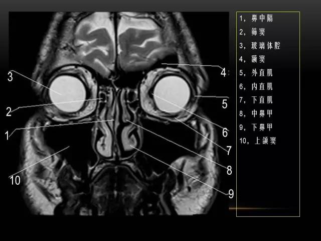 鼻腔鼻窦及颅底ct影像解剖,鼻窦解剖mri