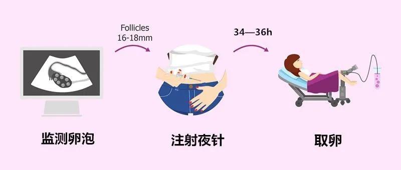 试管婴儿促排卵的最佳方案,试管婴儿促排卵有多少个方案