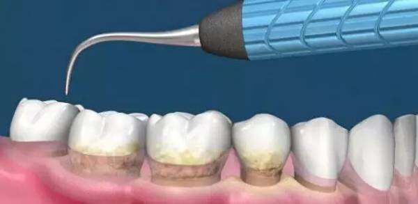 洗牙到底怎么洗好,洗牙洗的不干净