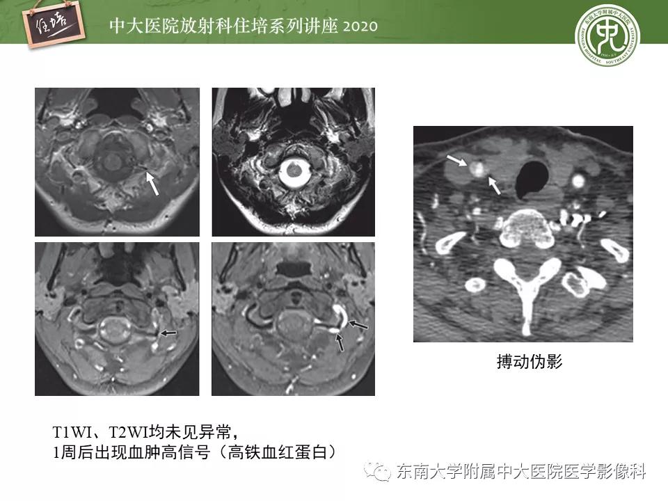 颈动脉夹层的超声表现及漏诊分析,动脉夹层与夹层动脉瘤是一样的吗