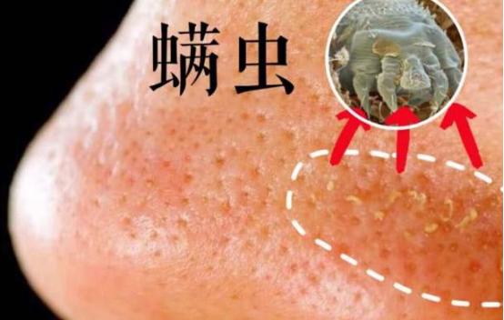 如何彻底根除脸部螨虫跟毛孔粗大,毛孔粗大螨虫打洞怎么办