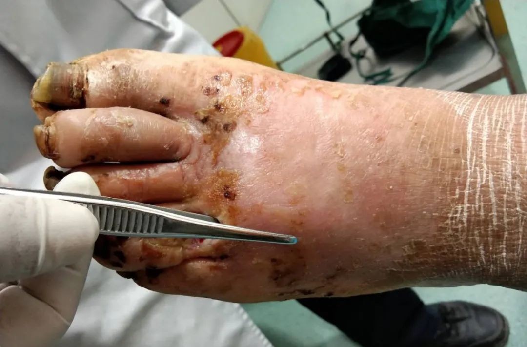 糖尿病足创面处理与组织修复,糖尿病足的强化治疗